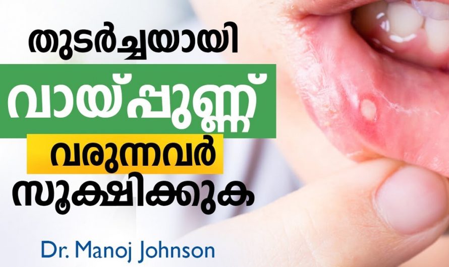 തുടർച്ചയായി വായ്പുണ്ണ് വരുന്നവരാണെങ്കിൽ ഇക്കാര്യങ്ങൾ പ്രത്യേകം ശ്രദ്ധിക്കുക. | Mouth Ulcer Malayalam