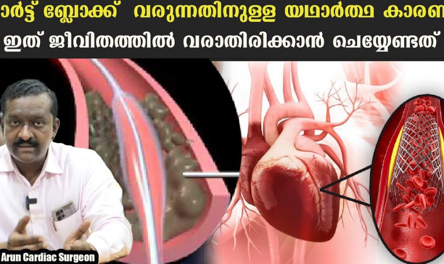 ജീവിതത്തിൽ ഹാർട്ട് ബ്ലോക്ക് വരാതിരിക്കാൻ ചെയ്യേണ്ട കാര്യങ്ങൾ. ഇത് കാണാതെ പോകല്ലേ. | Heart Block Reason