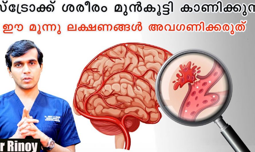 ജീവിതത്തിൽ സ്ട്രോക്ക് വരാതിരിക്കാൻ ഈ ലക്ഷണങ്ങളെ കണ്ടില്ല എന്ന് നടിക്കരുത്. | Prevent Stroke Health