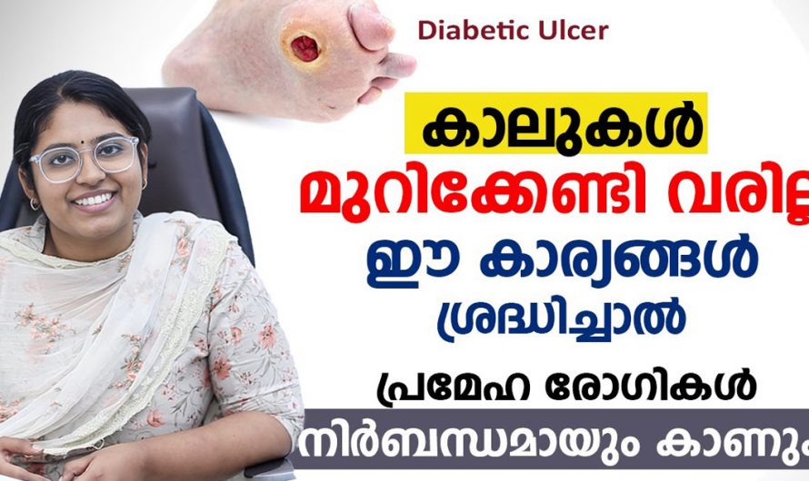 പ്രമേഹ രോഗികളുടെ കാൽ മുറിച്ച് മാറ്റുന്നത് ഒഴിവാക്കാൻ സാധിക്കുമോ? കണ്ടു നോക്കൂ. | Diabetic Foot Ulcer Malayalam