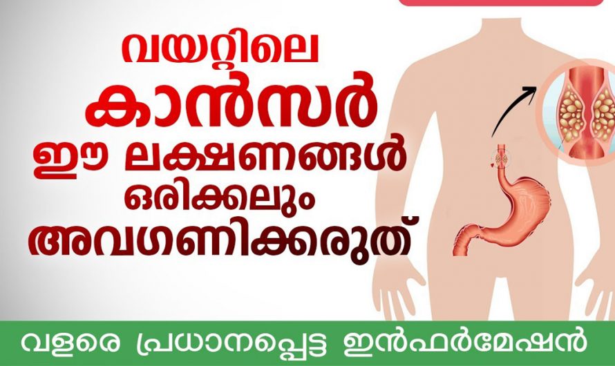 ശരീരം കാണിക്കുന്ന അപായ ലക്ഷണങ്ങൾ. ഈ ലക്ഷണങ്ങളാണ് പിന്നീട് ക്യാൻസർ ആയി മാറുന്നത്. | Stomach Cancer Health