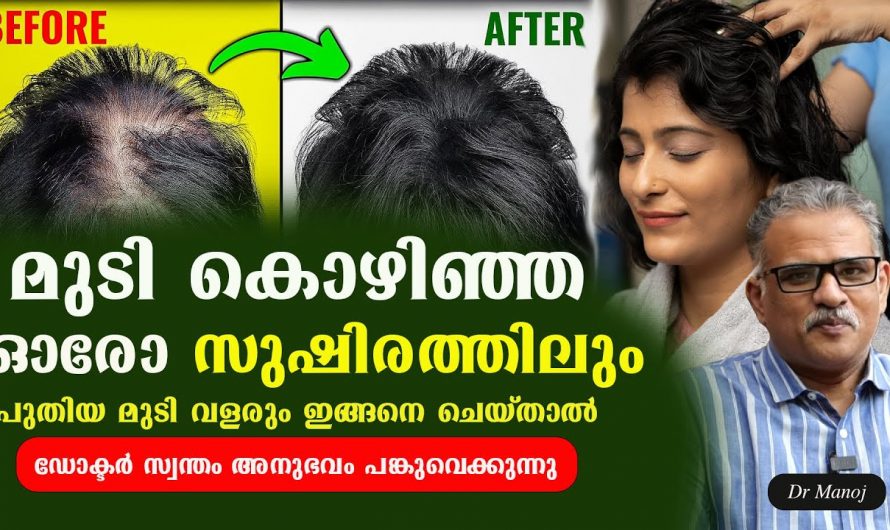 മുടി കൊഴിഞ്ഞുപോയ ഭാഗത്ത് ഇനി പുതിയ മുടികൾ കിളിർത്ത് വരും. ഇതുപോലെ ചെയ്യൂ. | Hair Loos Prevent Tip