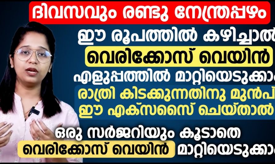 ദിവസവും രണ്ടു നേന്ത്രപ്പഴം ഈ രൂപത്തിൽ കഴിച്ചാൽ വെരിക്കോസ് വെയിൻ എളുപ്പത്തിൽ മാറ്റിയെടുക്കാം. | Varicose veins can be easily removed