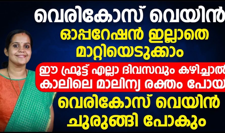 വെരിക്കോസ് വെയിൻ വന്നാൽ ഇനി ഓപ്പറേഷൻ ചെയ്യേണ്ട. ഡോക്ടർ പറയുന്നത് പോലെ ചെയ്യൂ. | Varicose veins can be replaced