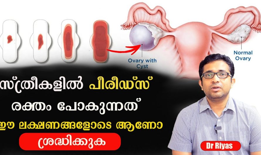 ആർത്തവ സമയത്ത് ഈ ലക്ഷണങ്ങളോടെയാണോ രക്തം പോകുന്നത്. എങ്കിൽ നിങ്ങൾ സൂക്ഷിക്കണം. | Women should not dismiss these period symptoms