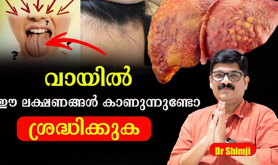 നിങ്ങളുടെ വായിൽ ഇതുപോലെ ഉള്ള ലക്ഷണങ്ങൾ കാണുന്നുണ്ടോ. എങ്കിൽ നിങ്ങൾ സൂക്ഷിക്കണം ഇതാണ് കാരണം. | Do you see these symptoms in the mouth