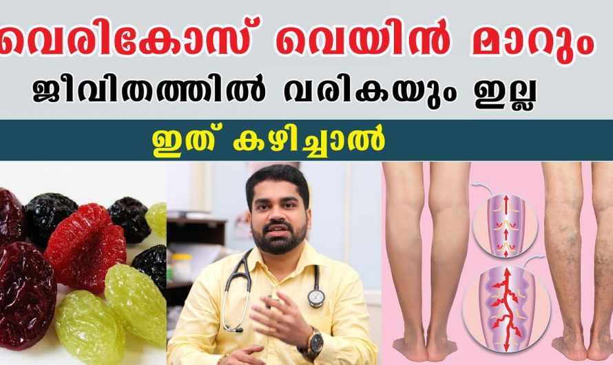 ഈ ലക്ഷണങ്ങൾ അറിഞ്ഞില്ലെങ്കിൽ വെരിക്കോസ് വെയിൻ ഒരിക്കലും മാറില്ല….