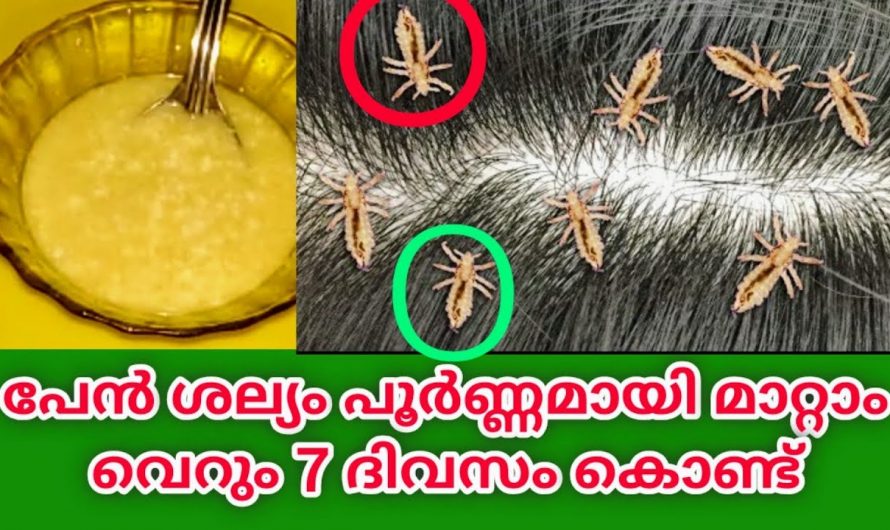 ഒറ്റ ദിവസം കൊണ്ട് പേൻ ശല്യം മാറ്റാം … ഈ മൂന്ന് ചേരുവകൾ മാത്രം മതി