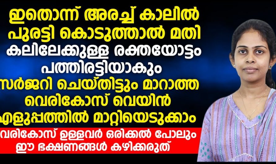 വെരിക്കോസ് വെയിനിന്നുള്ള പ്രധാന കാരണങ്ങൾ ഇവയൊക്കെയാണ്…