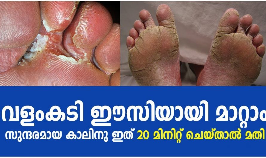 ഒറ്റ ദിവസം കൊണ്ട് കാലിലെ വളം കടി മാറും., ഇത് ചെയ്താൽ മതി..