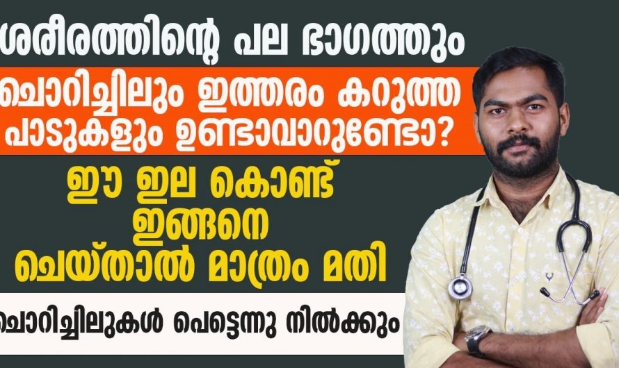 സോറിയാസിസ് ഒരു നിസ്സാര ചർമ്മരോഗം അല്ല ചികിത്സിച്ചില്ലെങ്കിൽ ഗുരുതരമാകും…