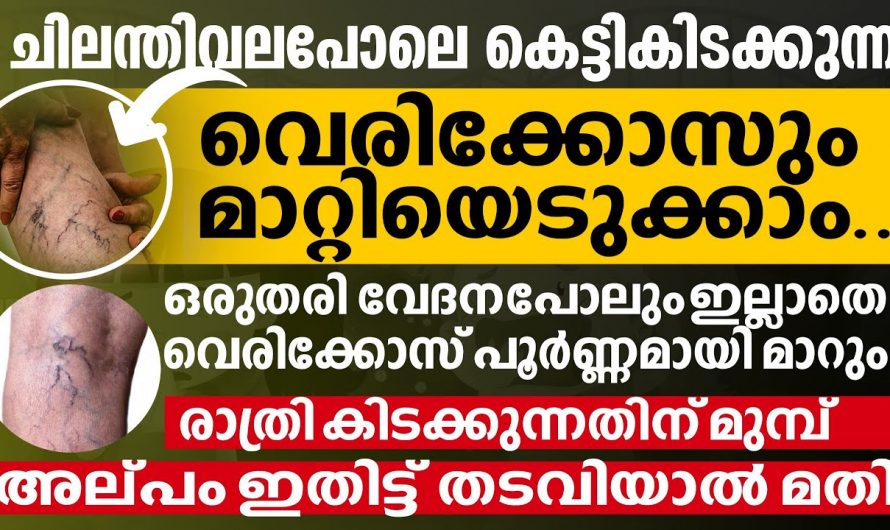 കാലിലെ ചൊറിച്ചിലും നിറമാറ്റവും വെരിക്കോസ് വെയിനിന്റേതാവാം, ചികിത്സിക്കുക അല്ലെങ്കിൽ ഗുരുതരമാവും…