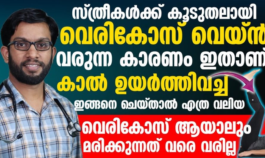 വെരിക്കോസ് വെയിൻ പൂർണ്ണമായും മാറുന്നതിന് ഇങ്ങനെ ചെയ്താൽ മതി, ഈ അറിവ് ഉപയോഗപ്പെടും…