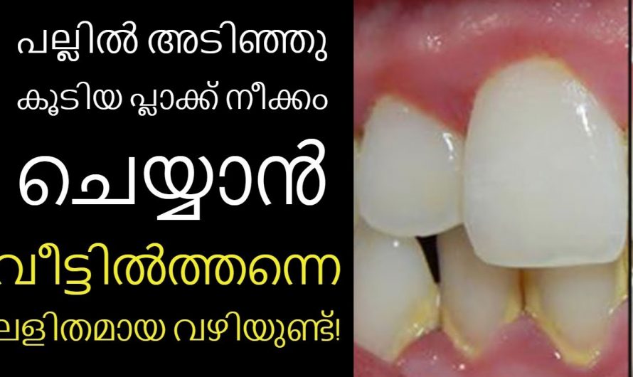 പല്ല് പളുങ്കുപോലെ വെളുക്കും.. ഈ രീതി ഉപയോഗിച്ച് നോക്കൂ…