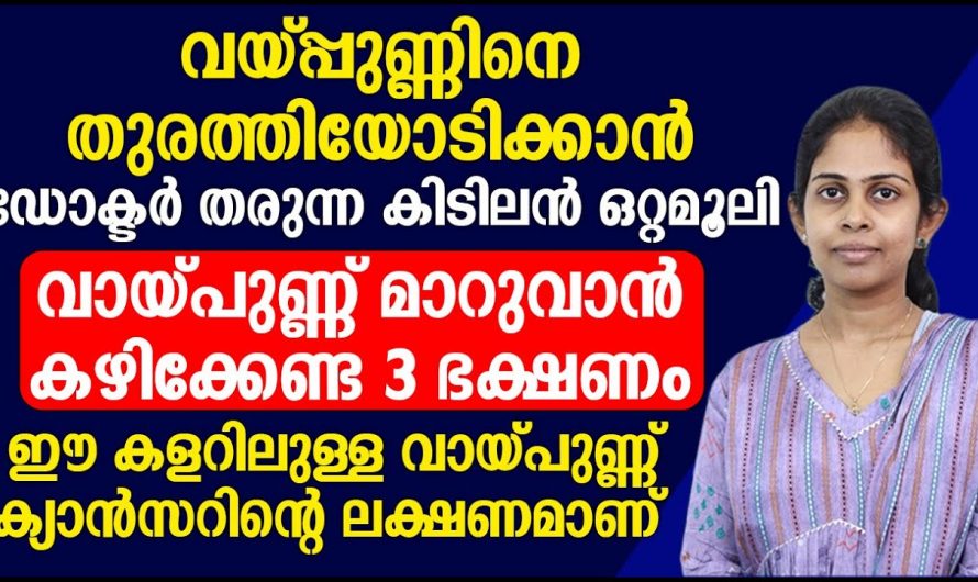 വിട്ടുമാറാത്ത വായ്പുണ്ണ് ഈ രോഗത്തിൻറെ ലക്ഷണമാണ്, ഉടൻതന്നെ ചികിത്സയ്ക്കു…