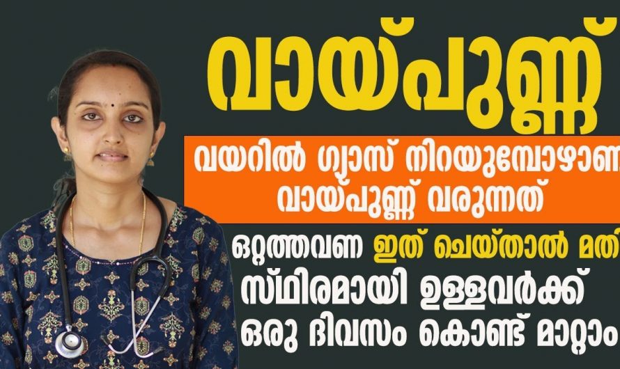 വായ്പുണ്ണ് ഒരു നിസ്സാര രോഗമല്ല, കാരണം തിരിച്ചറിഞ്ഞില്ലെങ്കിൽ ഗുരുതരമാവും….