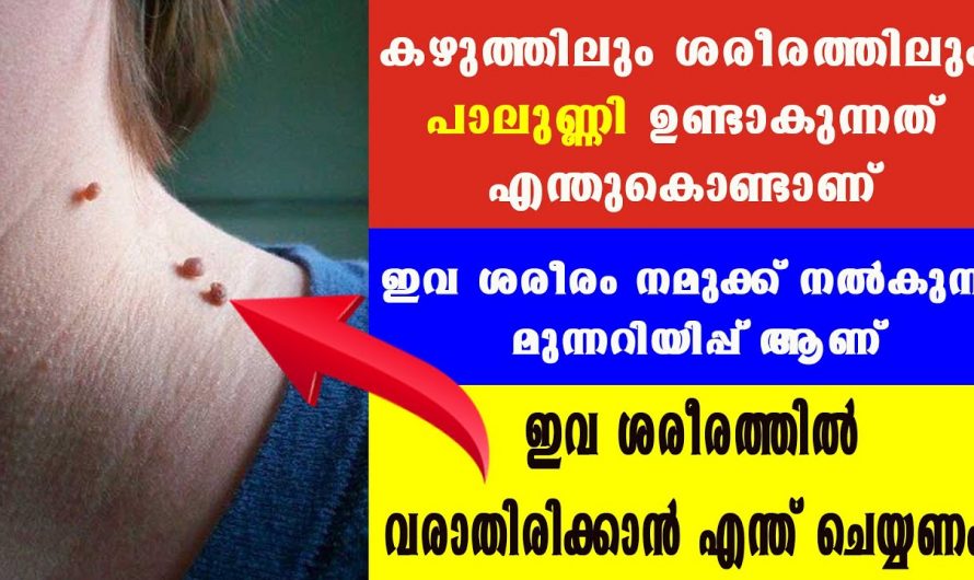 ചർമ്മത്തിൽ ഉണ്ടാകുന്ന പാലുണ്ണി നിസാരക്കാരനല്ല, ഇതിന് പിന്നിലെ കാരണം ആരെയും ഞെട്ടിക്കും…