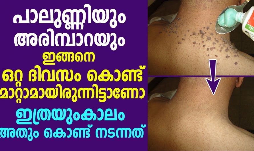 അരിമ്പാറയും പാലുണ്ണിയും ഒറ്റ ദിവസത്തിൽ മാറ്റാം, ഈ മൂന്ന് ചേരുവകൾ ഉണ്ടായാൽ മതി…