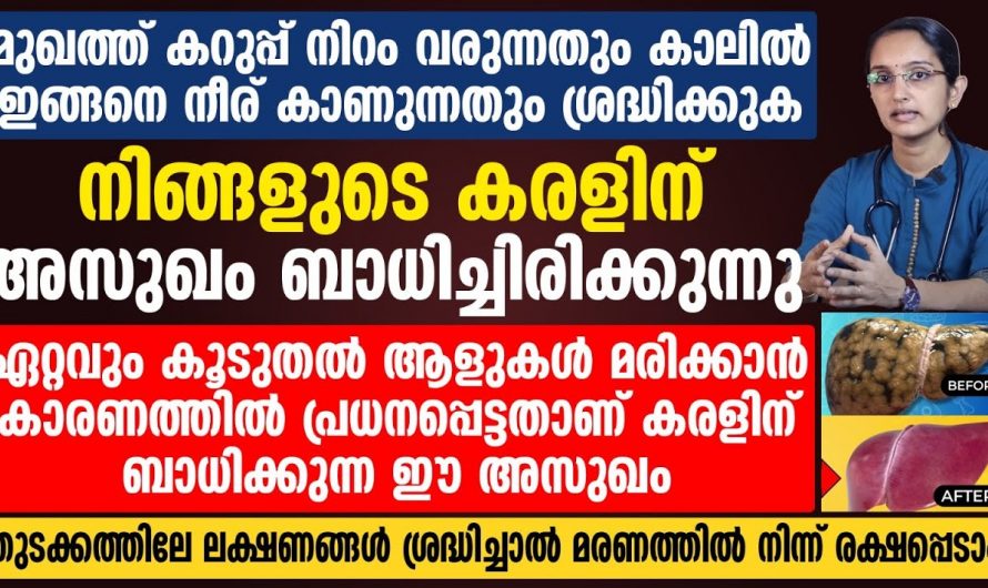 ചർമ്മത്തിൽ കാണപ്പെടുന്ന ഈ മാറ്റം കരൾ രോഗത്തിന്റെ ലക്ഷണം ആകാം, സൂക്ഷിക്കുക…